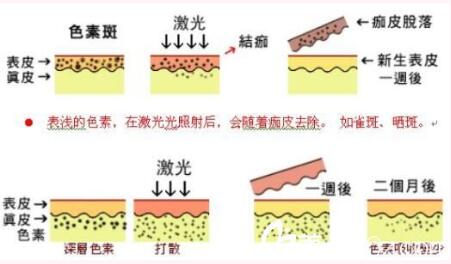 昆明華美美萊美容醫院俞滿昌激光祛斑