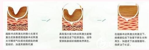 昆明華美美萊美容醫(yī)院黃夢婷祛痘原理