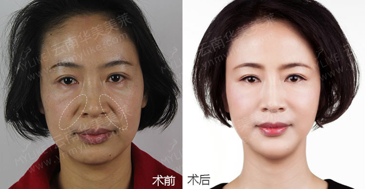 注射玻尿酸除皺手術(shù)后，需要注意哪些事項(xiàng)？