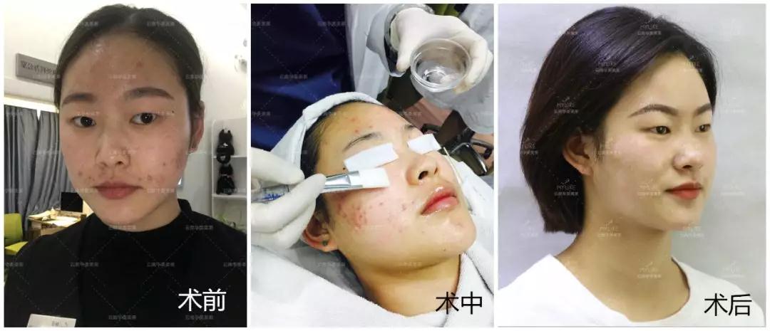 經常長痘，美萊果酸祛痘效果怎么樣