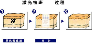 麗江日曬斑怎么祛除價(jià)格多少