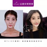 昆明打玻尿酸哪家好，打玻尿酸副作用有哪些？