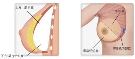 怎樣做才能讓豐胸手術(shù)的恢復時間更快一些呢