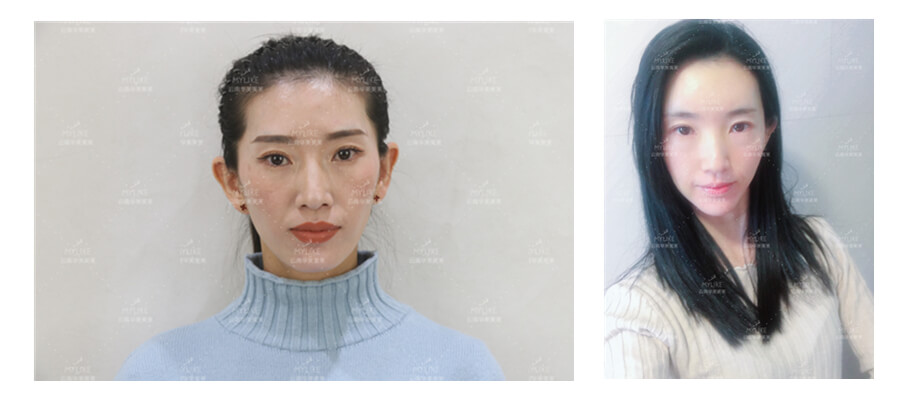 2011年環球游艇模特大賽十佳及單項獎小姐姐必做的醫美項目！！美萊雙十一get好物推薦