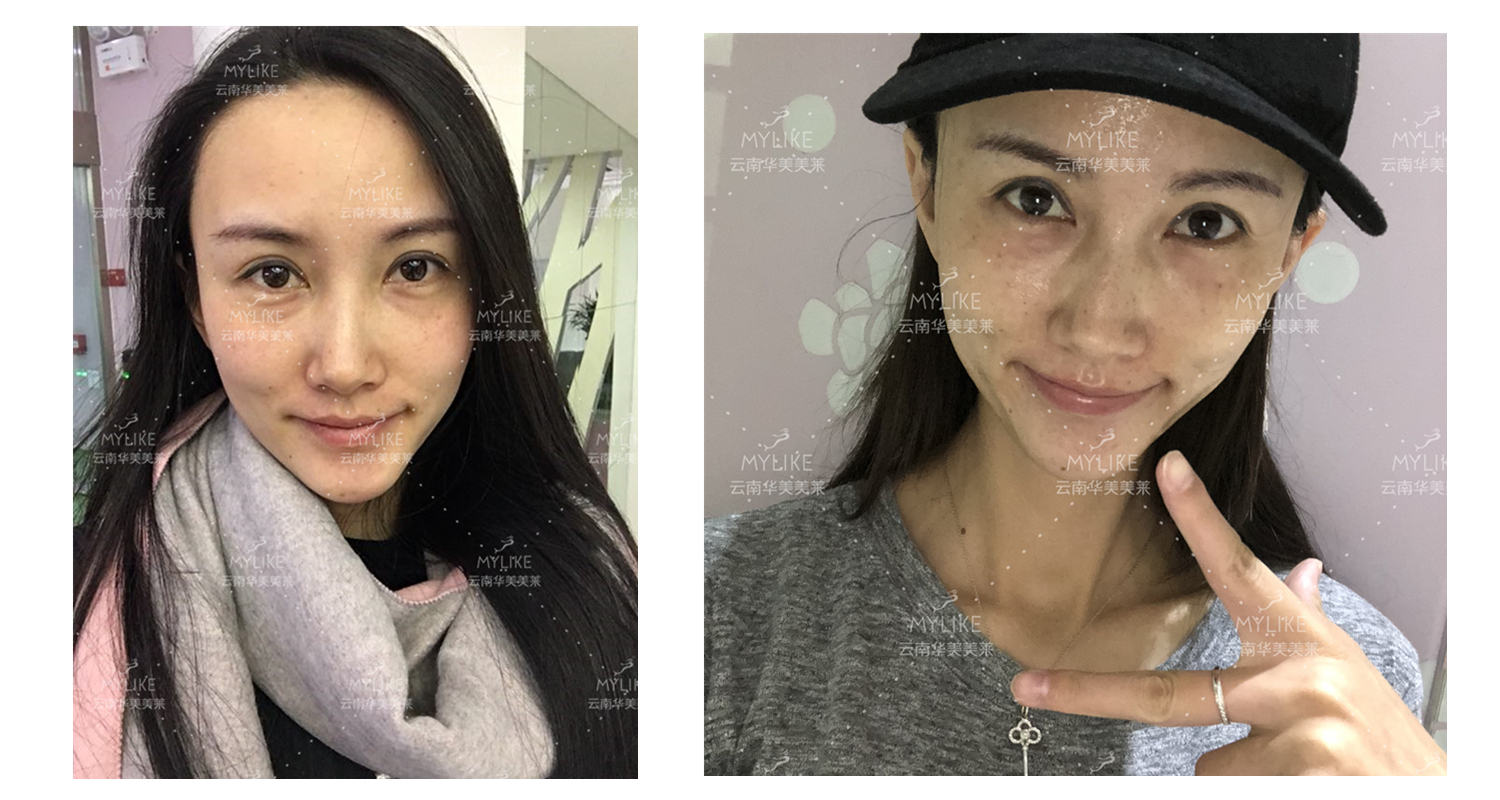 2018年“魅力絲路 時尚昆明”車模大賽勝者必要做的醫美項目?。∶廊R雙十一get好物推薦