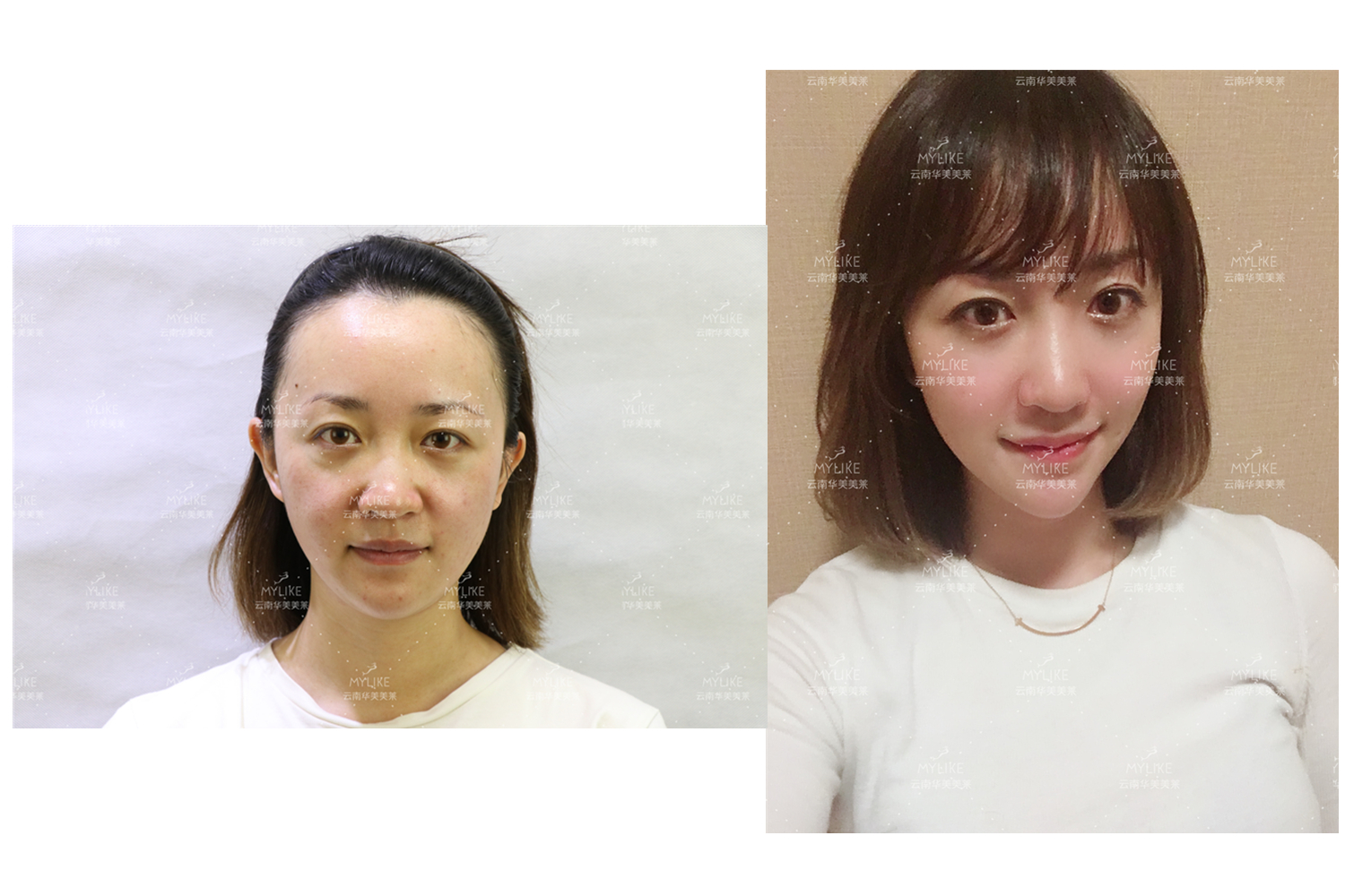 出演電視劇《官渡人家》的小姐姐必做的醫(yī)美項目?。∶廊R雙十一get好物推薦