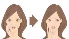 泉州面部皺紋如何去除比較好