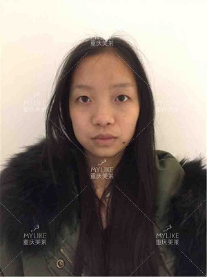 美萊案例lucy對(duì)比圖后