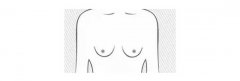 乳房下垂做假體隆胸效果怎么樣