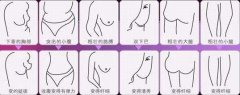 沈陽做抽脂減肥費用是多少