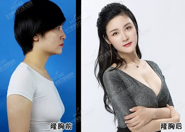 <a href='/cs/' target='_blank'><u>長沙美萊</u></a>年終隆胸盛惠，該選圓盤or水滴？