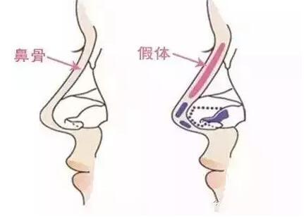 重慶假體隆鼻哪家醫院好?秀氣的鼻子更配你漂亮的臉蛋！