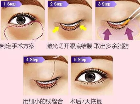 <a href='/sy/' target='_blank'><u>沈陽美萊</u></a>講解眼袋到底有多嚇人，你敢看嗎？
