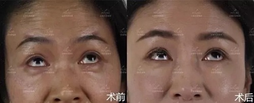 2018年過得很開心的你，皺紋有沒有增多？