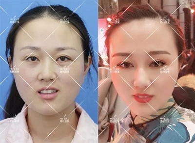 有些眼睛雙眼皮拯救不了，就來蘇州美萊做眼綜合手術！