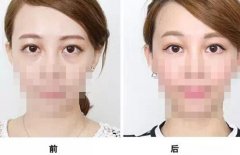 通過手術祛眼袋多久看都效果?會有疤痕嗎？