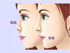 南京玻尿酸隆鼻能維持多長時間？