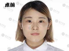 重慶華美雙眼皮大挑戰，術后半個月到底能不能被發現是割的？