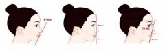 重慶做開(kāi)眼角之后不能吃哪些東西？
