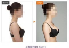 假體隆胸價格是多少？