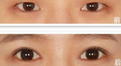 上眼瞼下垂怎么辦？