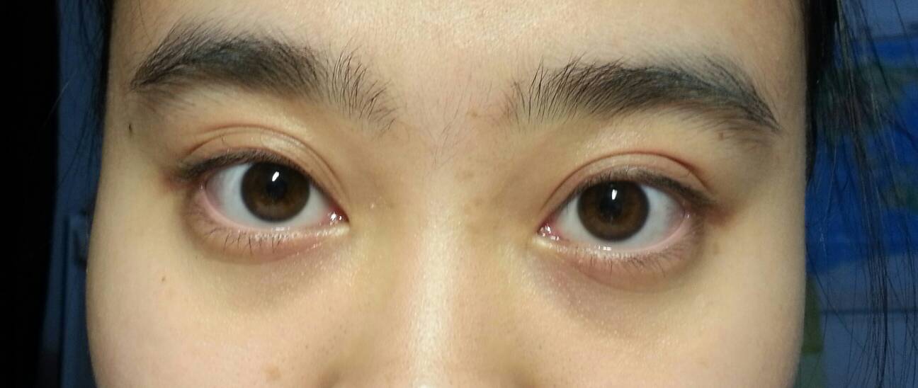 手術消除眼袋3大疑難問題解答!