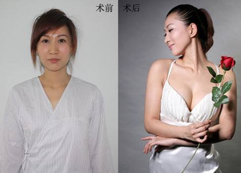 豐胸醫(yī)院怎么選？