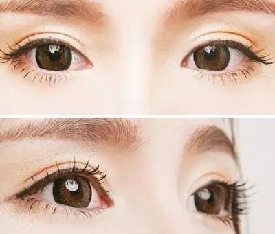 雙眼皮埋線多少錢？