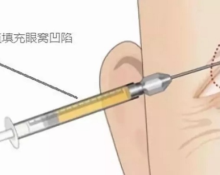 新年集福，怎可讓“眼窩凹陷”影響運氣？