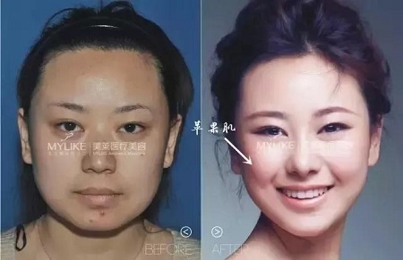 這四種臉型打玻尿酸+瘦臉，立刻變專業小V臉
