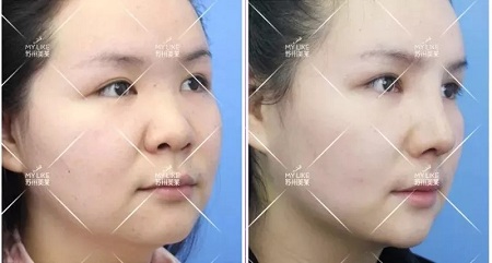 想隆鼻又不想用自己的軟骨，急需一個男票！