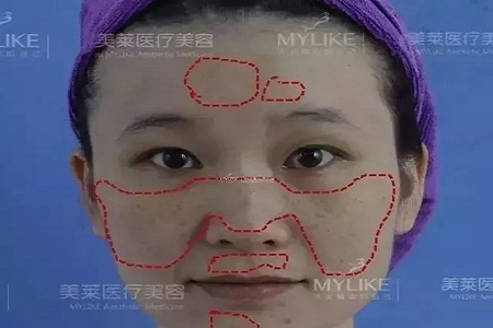 五官很好看，為什么不把臉上的斑去掉？