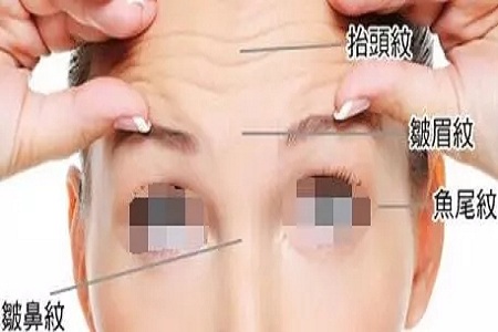 玻尿酸除皺，輕松一針呈現更美的自己