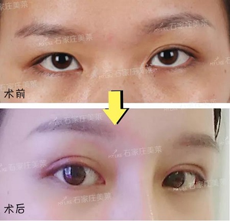 明星的眼和鼻，術(shù)后半個(gè)月Get專業(yè)混血臉！可萌可酷美翻了~