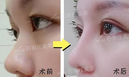 術(shù)后半個(gè)月Get專業(yè)混血臉！可萌可酷美翻了~