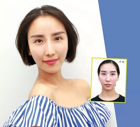 她往臉上注射了點玻尿酸，天天被夸18歲！