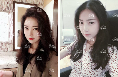 玻尿酸拯救失去的少女感！！！你也能和娜比一樣美！