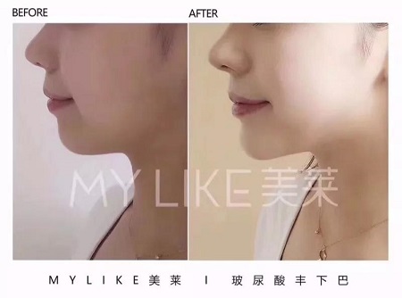 沒想到！除了瘦臉“它”也能瘦臉，而且效果超贊！