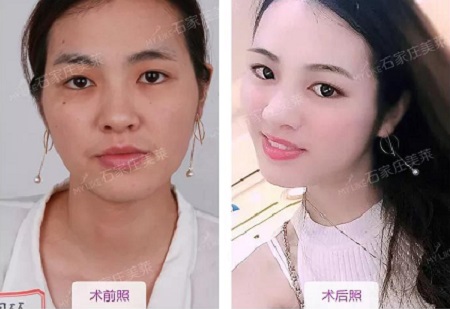 這幾種臉型妹紙，千萬別做面部脂肪填充！！！