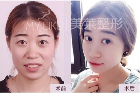 這幾種眼睛割完雙眼皮超美！不信，看她們的術(shù)后效果~