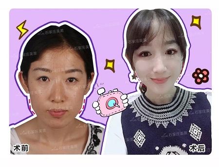 方臉妹紙做完下頜角，看上去減齡5歲！