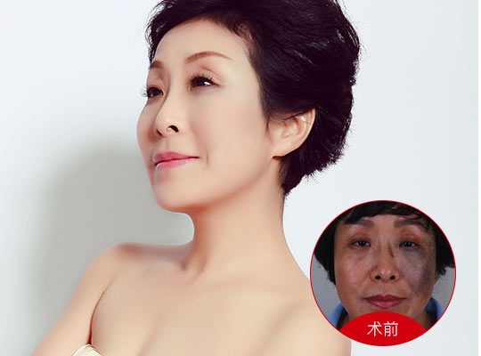 武漢深藍(lán)射頻價(jià)格是多少？