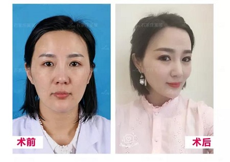 松弛的臉做完*雕，比同齡人足足年輕10歲！