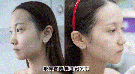 隆鼻價(jià)格內(nèi)幕曝光！水超深！