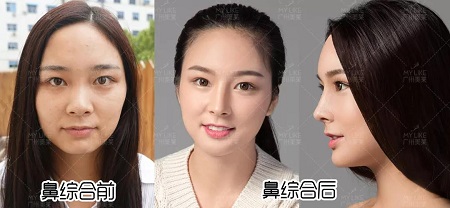 隆鼻價(jià)格內(nèi)幕曝光！水超深！