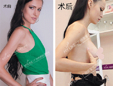 3月21日，國際乳房整容醫師穆大力來了！親診名額限量預約！