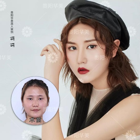會縫衣服就會割雙眼皮！3天速成還用朋友試手？