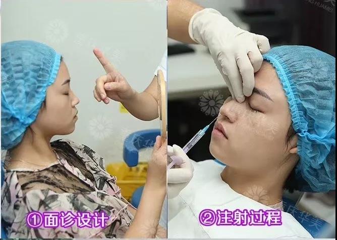 自測(cè) | 30秒就知道你適不適合打玻尿酸！