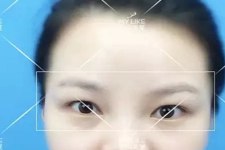 腫眼泡不僅難看還更容易衰老！