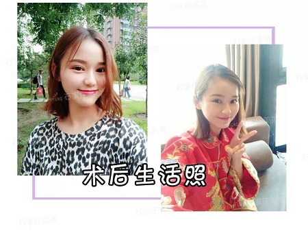 我近視做雙眼皮，對眼睛有影響嗎？圍觀小姐姐術后反饋！